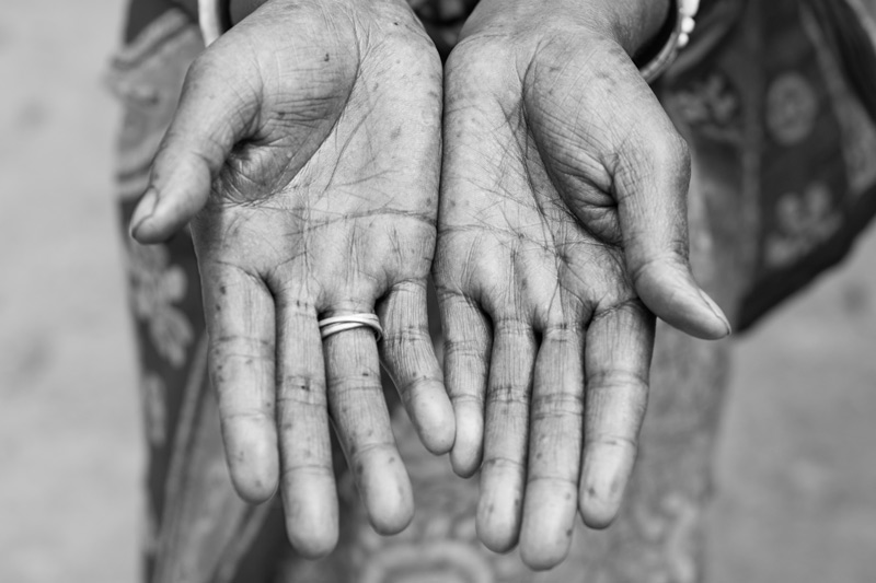 The reducing melanosis spots on the hands of Nomita Biswas as a result of consumption of arsenic-free drinking water from the pond at village Madhusudankati, North 24 parganas district, West Bengal